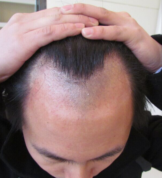 我在南昌大麦微针，上演重返20岁