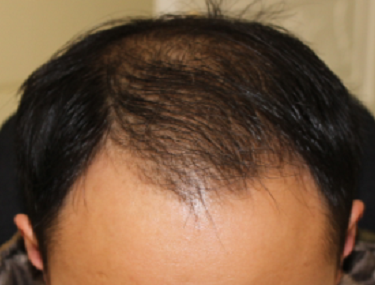 女友因脱发甩我，我却更爱她了。得利于南昌大麦微针（原科发源）