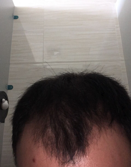 广州植发记，3680单位记录植发效果！