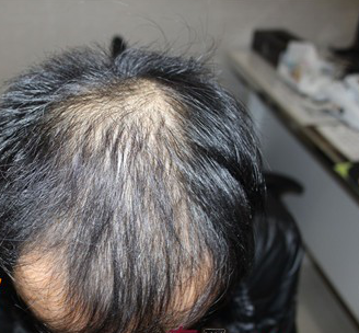 植发3510单位，大家一起来看效果