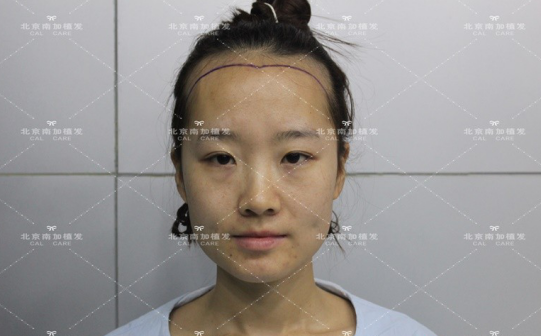 发际线调整案例——很幸运，重新变回小仙女