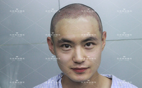 发际线调整案例，南加植发让我的颜值改变，更有自信