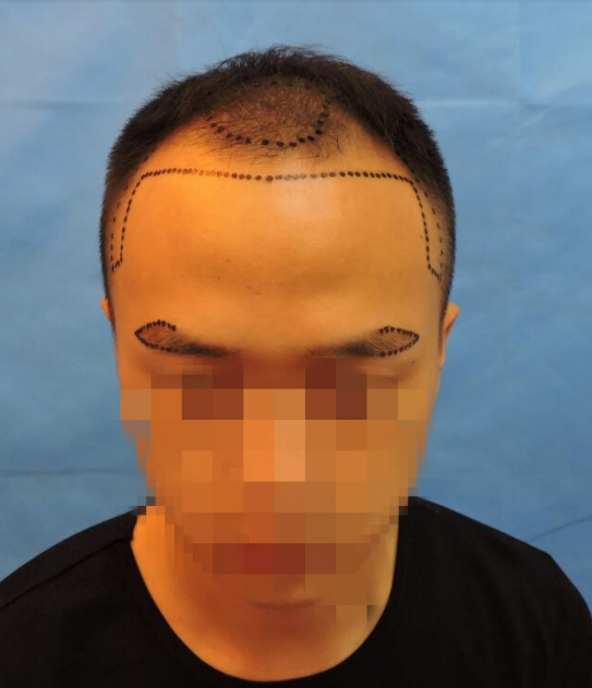 发际线、眉毛种植3600案例——我来讲述怎么变成一位帅小伙