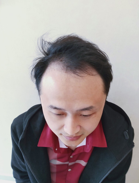 北京南加发际线调整案例，拯救“恨天高”发际线