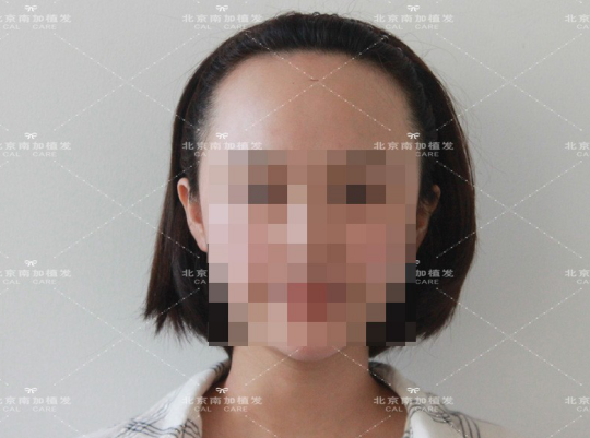 北京南加植发2500单位，变回明星娃娃脸