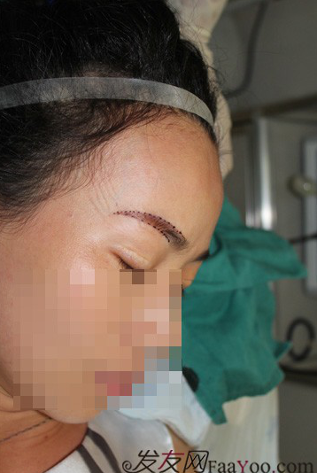 南昌的妹子，种植了眉毛和发际线，欢迎发友们围观