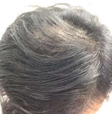 二次植发，发现不一样的自己，新发现植发记录贴