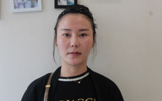 北京南加发际线种植，银盆大脸终于修炼成了邻家幼幼