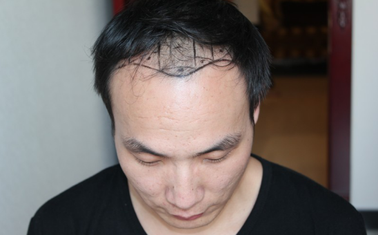 北京植发2700单位，我一步步的拾回了自信