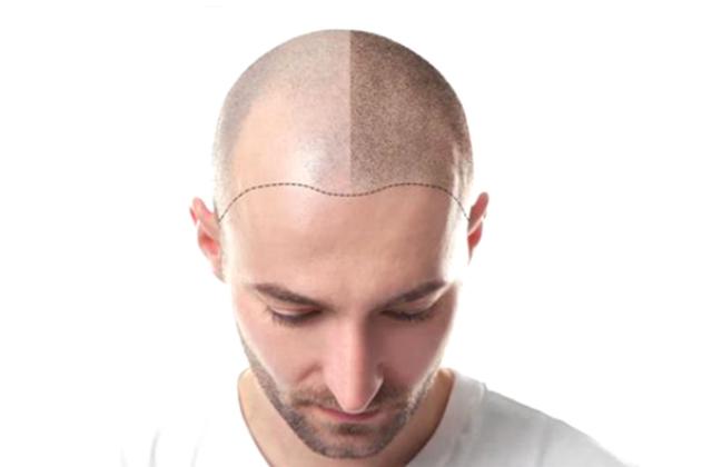 纹发--治疗脱发的一种新型手段
