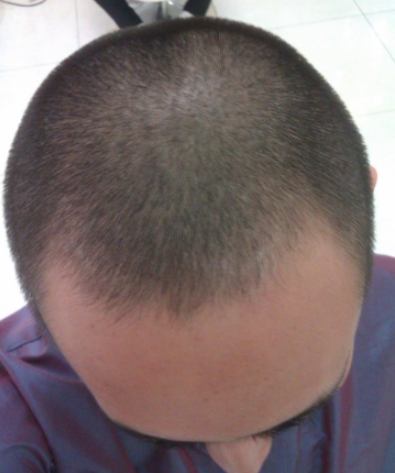 北京植信实录发际线下调+额角加密2026个单位