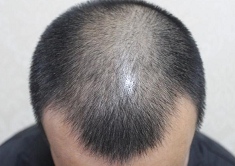 植发日记南昌广济植发，慢慢看我改变从此恢复自信