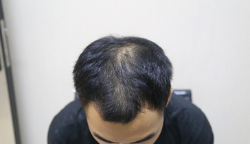 广州新发现植发5个月，终于变回帅小伙