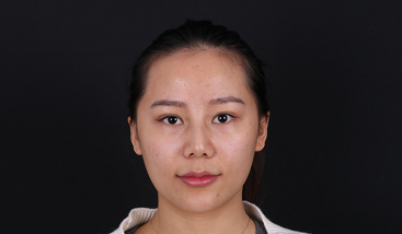 我在北京植了发，谢谢发友网给我的帮助，分享植发日记