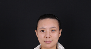  植发好医生北京发际线种植，我也是张娃娃脸了