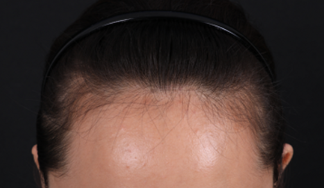  我在北京微美植发，调整发际线后，大额头终于不见了