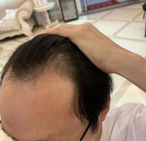 大麦微针植发，植发后三天自信从头开始