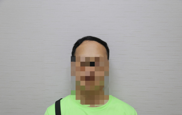 广州植发3950单位案例，见证记录