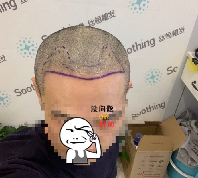 发友网与机构活动植发，前后效果对比、记录