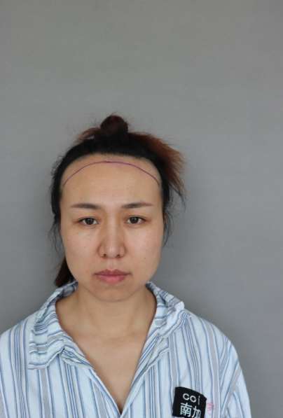 北京南加种植发际线2200单位，效果如何看我恢复情况