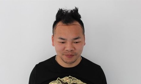 遇见更好的自己，参加发友网组团北京南加植发活动术前术后全过程