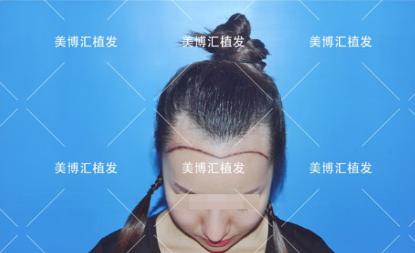 来看我的发际线植发经历，大脸怎么一步步变精致小脸的