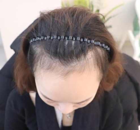 天生发际线高，通过成都大麦微针植发的一次改变