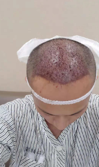 广州大麦微针自信从头开始PSE+PTT ，听我仔细讲述