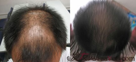 南昌大麦微针植发3000单位，植发治好了我的败顶