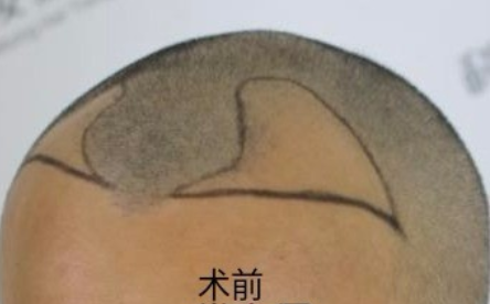 分享杭州大麦微针植发2700单位案例，希望能帮到你