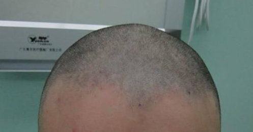 植发2000单位，苏州爷们儿勇闯大上海植发医院！