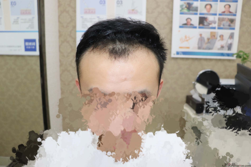 大麦微针发际线2400单位种植案例，来看看我的植发前后