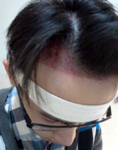 北京植信植发1800单位记录，变回那个阳光明媚的小伙子