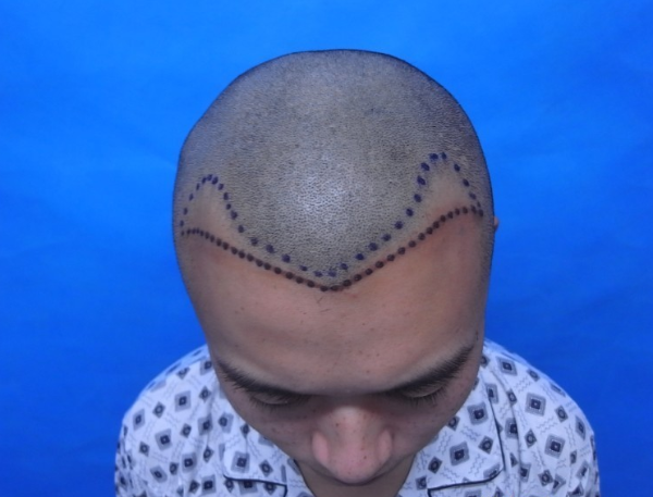 北京植信发际线种植1400单位，来看看一年前一年后的对比图