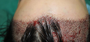 女生们进来看看大麦微针是如何把我的大额头发际线给整治好的