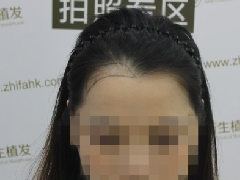 新生植发帮助我解决“美人尖”的尴尬