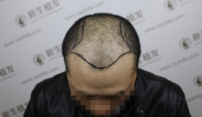 向广州新生植发致敬，治好了我的N级脱发！