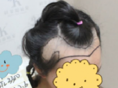 额角头发稀疏在大麦微针植了发，3480单位来看看改变