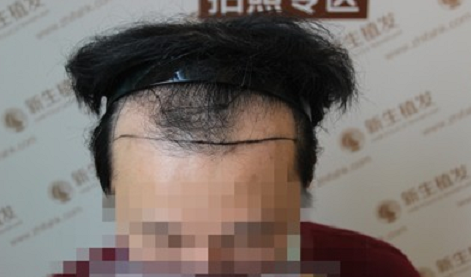 相约广州新生植发，拯救M型脱发！