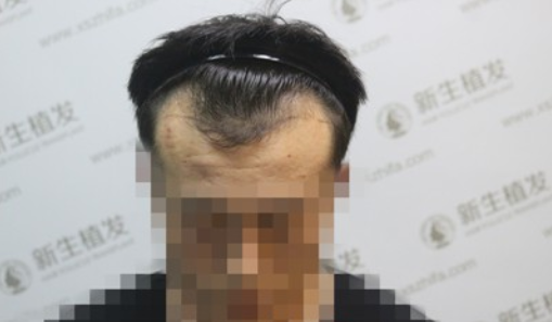 拼搏的年纪遇上脱发，我只能选择去广州新生植发了