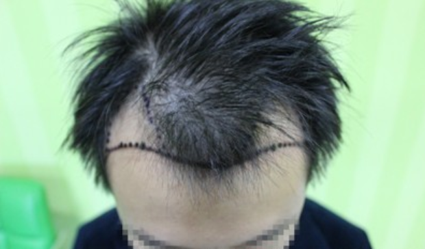 发际线移植，广州新生植发11个月后大变样