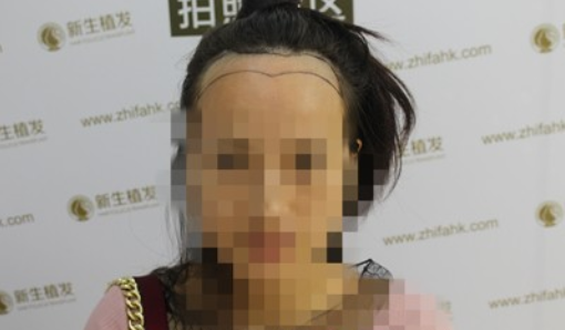 广州新生发际线种植案例，看看六个月恢复的怎样