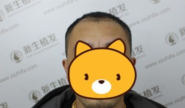 杭州新生植发3500单位，还我自信与帅气