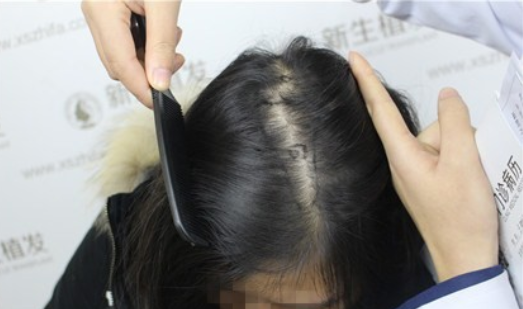 杭州新生植发医院，一场脱发困扰与时髦造型的博弈 