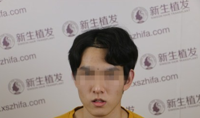 杭州新生植发2000单位，植发前我的头是夜空中最亮的反光星