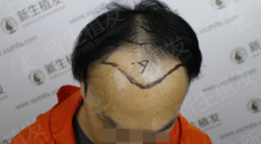 广州新生植发3500单位，6个月“年轻”10岁不止！