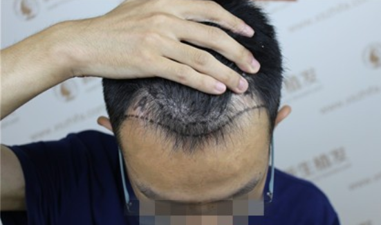 广州新生植发案例，感谢赐予我帅气