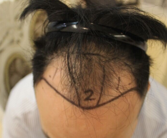 上海大麦微针fue+ptt 3600单位，效果满意看看前后对比图