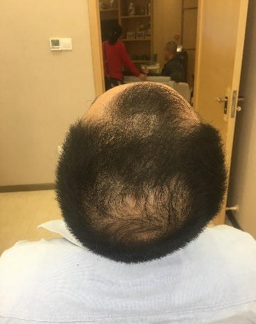 分享m+o植3600单位，希望我的头发越来越茂密