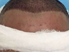 大麦微针植发2700单位，植出自信来